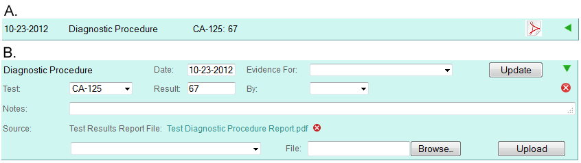 A fictitious ovarian cancer patient Diagnostic Procedure history event shown in single line display mode (A) and detailed display mode (B) in Colabrativ's Clinical Entry and Operations (Cleo) application.  All of the personal information displayed in this figure is fictitious, and does not represent a real individual or their medical history.