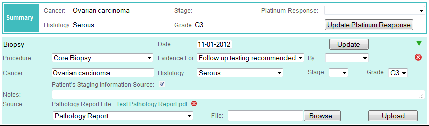 A fictitious ovarian cancer patient Summary and Biopsy history event shown in the detailed display mode in Colabrativ's Clinical Entry and Operations (Cleo) application.  All of the personal information displayed in this figure is fictitious, and does not represent a real individual or their medical history.